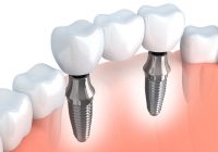 Implanty stomatologiczne Toruń