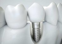 Implanty zębów w jeden dzień – Stomatologia estetyczna Toruń